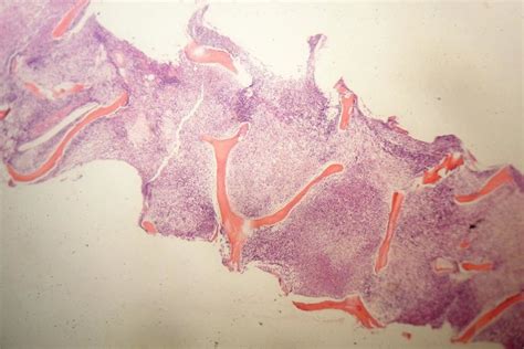 Trephine biopsy section from a patient with Folliculer lymphoma showing... | Download Scientific ...