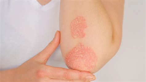 Psoriasis Legs Treatment