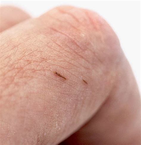 How to remove a splinter: Methods and tips