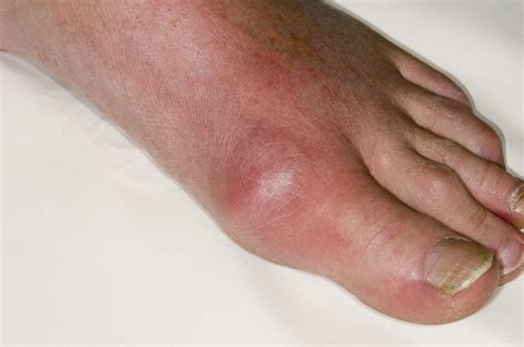 Treatment and management of gout: the role of pharmacy - The Pharmaceutical Journal