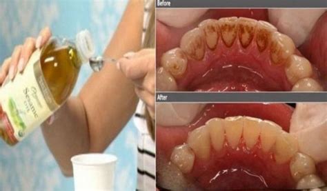 The oldest way to clean the teeth is by oil pulling. This method was used for centuries and is a ...