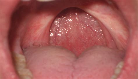 Is it good to remove uvula?