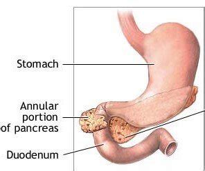 Annular pancreas - Surgery Superspeciality MCQS