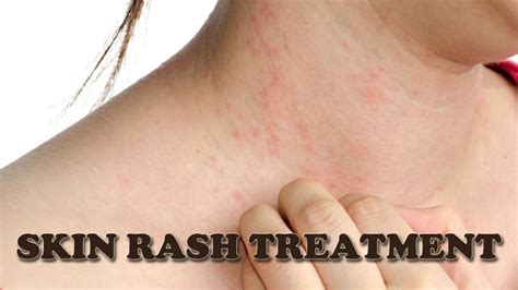 Medicine For Itchy Skin Rash - MedicineWalls