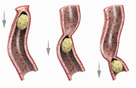 An ileus is a common complication of abdominal surgery where the normal ...