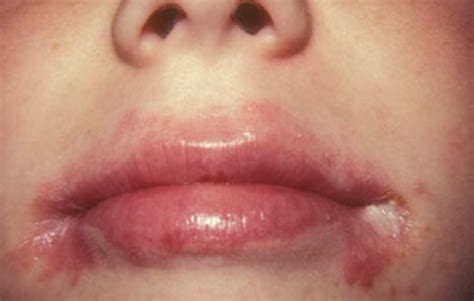 OTC Angular Cheilitis Treatment Doesn't Work?