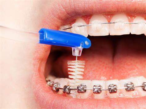 Tips on Taking Care of Your Braces - The Dedicated House