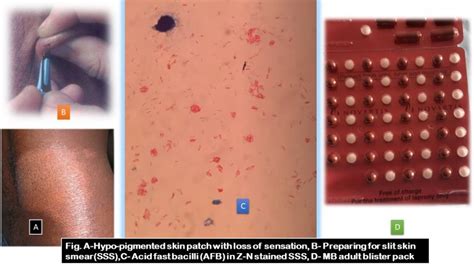 Mycobacterium leprae: Introduction, Morphology, Pathogenicity, Lab Diag