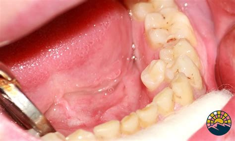 Hyperdontia Causes