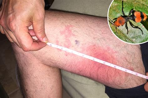 Florida Man in Excruciating Pain After Being Stung by 'Cow Killer' Ant ...