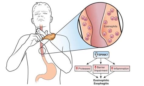 Eosinophilic Esophagitis - Symptoms,causes,risk Factors & Complications