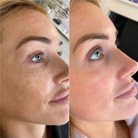 Laura Anderson has all her freckles removed in ‘extreme facial peel’ and says skin damage caused ...