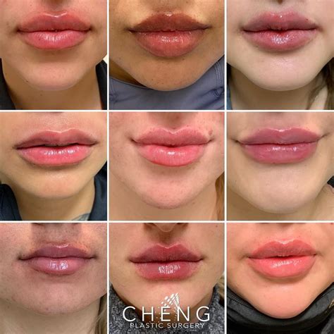 Cheng Plastic Surgery & Medspa on Instagram: “Lip Inspo ⁣ ⁣ Here is just a handful of our ...