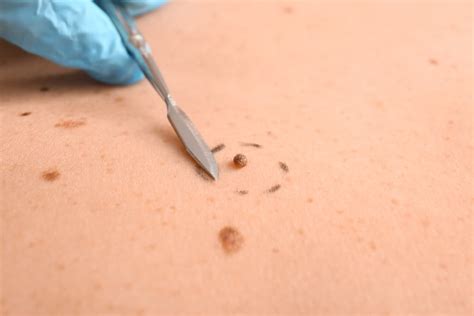 Can Moles be Removed Permanently? What are Different Methods to Remove Moles?