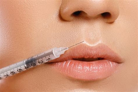 Lip Fillers & Lip Filler Trends - by Leigh Reese for Dermascope Magazi – SkinRX Clinical Spa