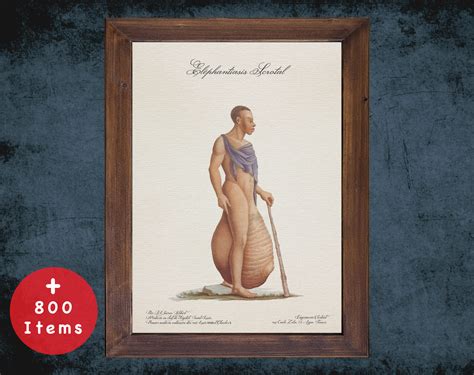 ELEPHANTIASIS SCROTAL Anatomy Art Print for Medical Student Gift, Dermatologist and Dermatology ...