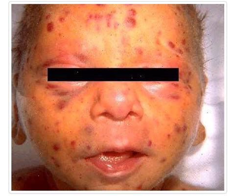 Congenital Rubella Syndrome Blueberry Muffin Rash