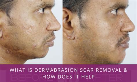 What is Dermabrasion Scar Removal & How Does It Help – Richardson's Plastic Surgery Hospitals