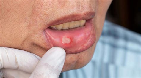 Canker sores and gluten sensitivity: A painful puzzle | Registered Dental Hygienists