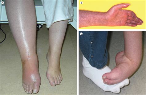 Clinical features and pathophysiology of complex regional pain syndrome - The Lancet Neurology