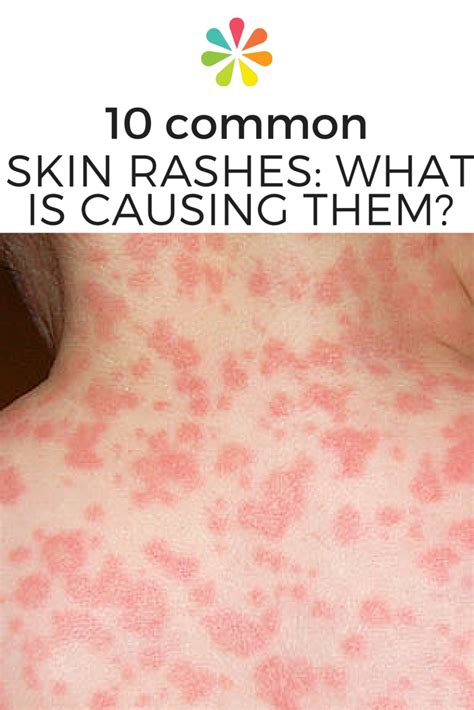 Identifying Skin Rashes In Adults