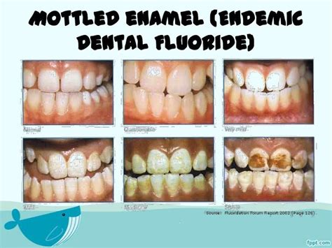 Fluoride and their role in dental caries prevention