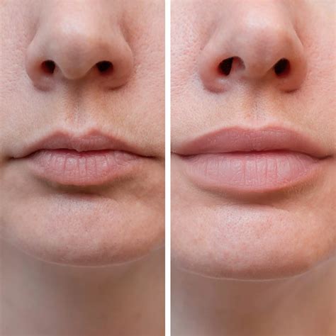 Restylane Kysse Lip Fillers in Santa Rosa and Healdsburg