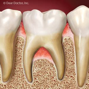 Gum Infection Around Tooth Roots Calls for Immediate Action