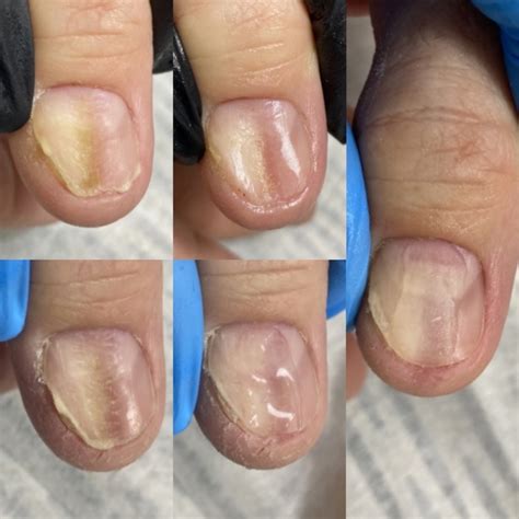 The furrows on nail plate One of the most common subological problems is furrows on the nails ...