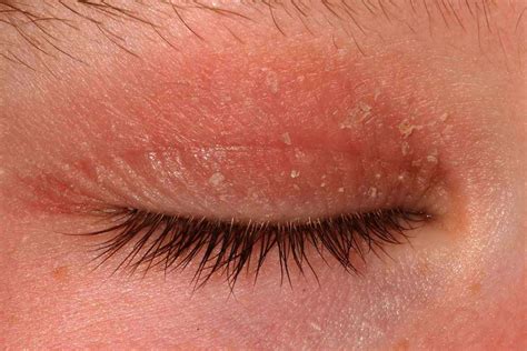 Eyelid Dermatitis: Symptoms, Causes, and Treatments