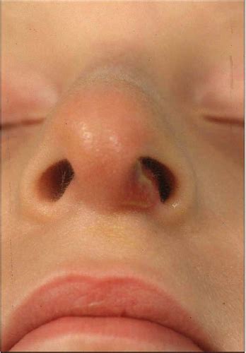 Nasal Vestibulitis|Treatment|Causes|Signs|Symptoms|Risk Factors | atelier-yuwa.ciao.jp