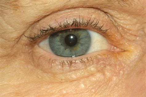 Syringoma: Condition and Treatment