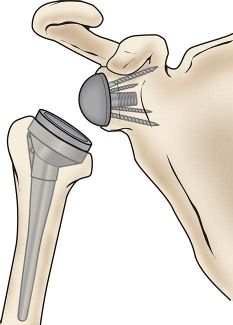 Reverse Total Shoulder Replacement - OrthoInfo - AAOS