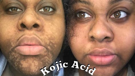 Kojic Soap Side Effects