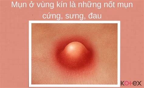 Nổi mụn ở vùng kín: Nguyên nhân & Cách điều trị - Kotex