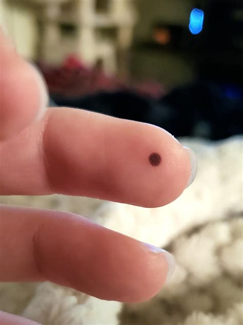 My blood blister is a nearly perfect circle : r/mildlyinteresting