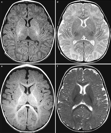 Metabolic Diseases of the Brain | Radiology Key