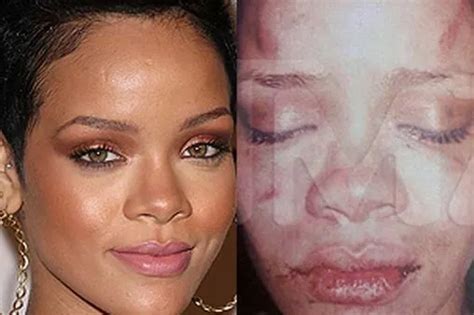 Rihanna's battered face: Leaked picture shows injuries after alleged ...