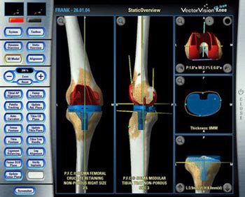 Computer Assisted Total Knee Replacement | Knee Specialist in Mumbai ...