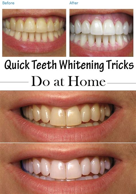 How To Use Zoom Whitening At Home