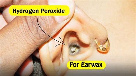 How to Use Hydrogen Peroxide To Remove Earwax? - YouTube