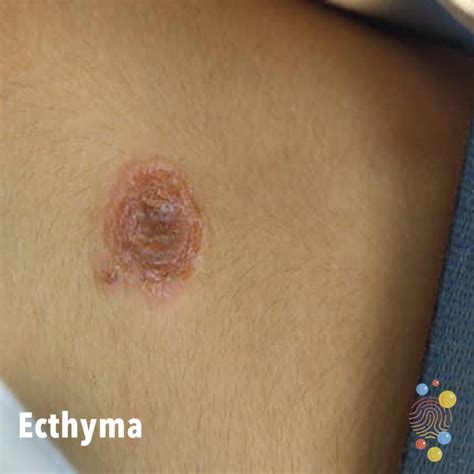 Ecthyma gangrenosum - Skin Deep