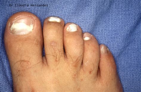 A guide to the types of toenail fungus – Arizona Foot Doctors