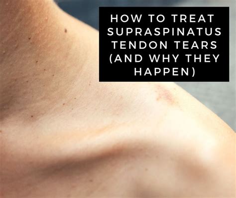 A Guide to Supraspinatus Tendon Tears (Rotator Cuff Injury ...