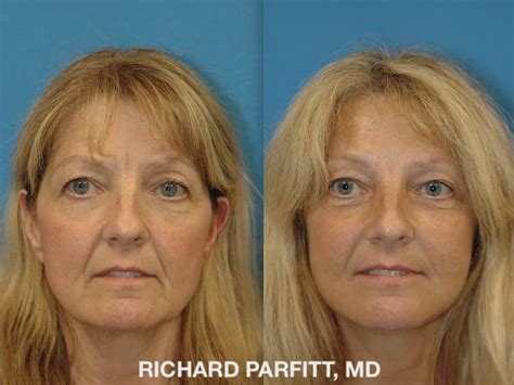 Facelift Before and After Photos - Dr. Richard Parfitt