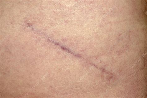 Scar after hip replacement surgery - Stock Image - C015/6033 - Science Photo Library