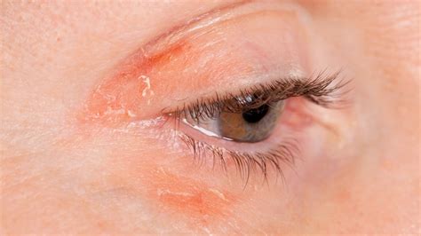 Rashes Around The Eye | Renew Physical Therapy