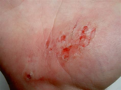 Check these interesting Facts about Abrasions!!