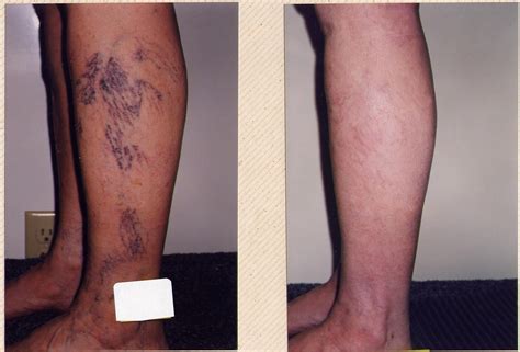 Sclerotherapy | Varicose Vein Spider Vein Melbourne Sclerotherpay Treatment