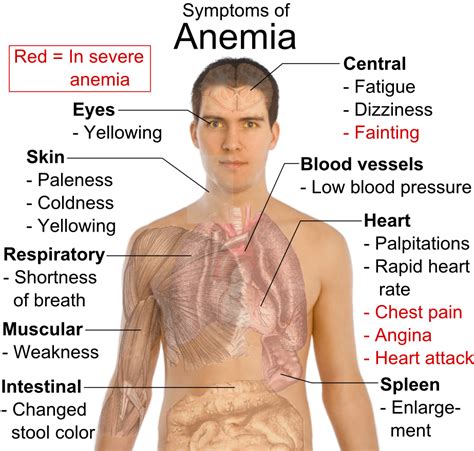 Thalassemia Archives - Jeffrey Sterling, MD